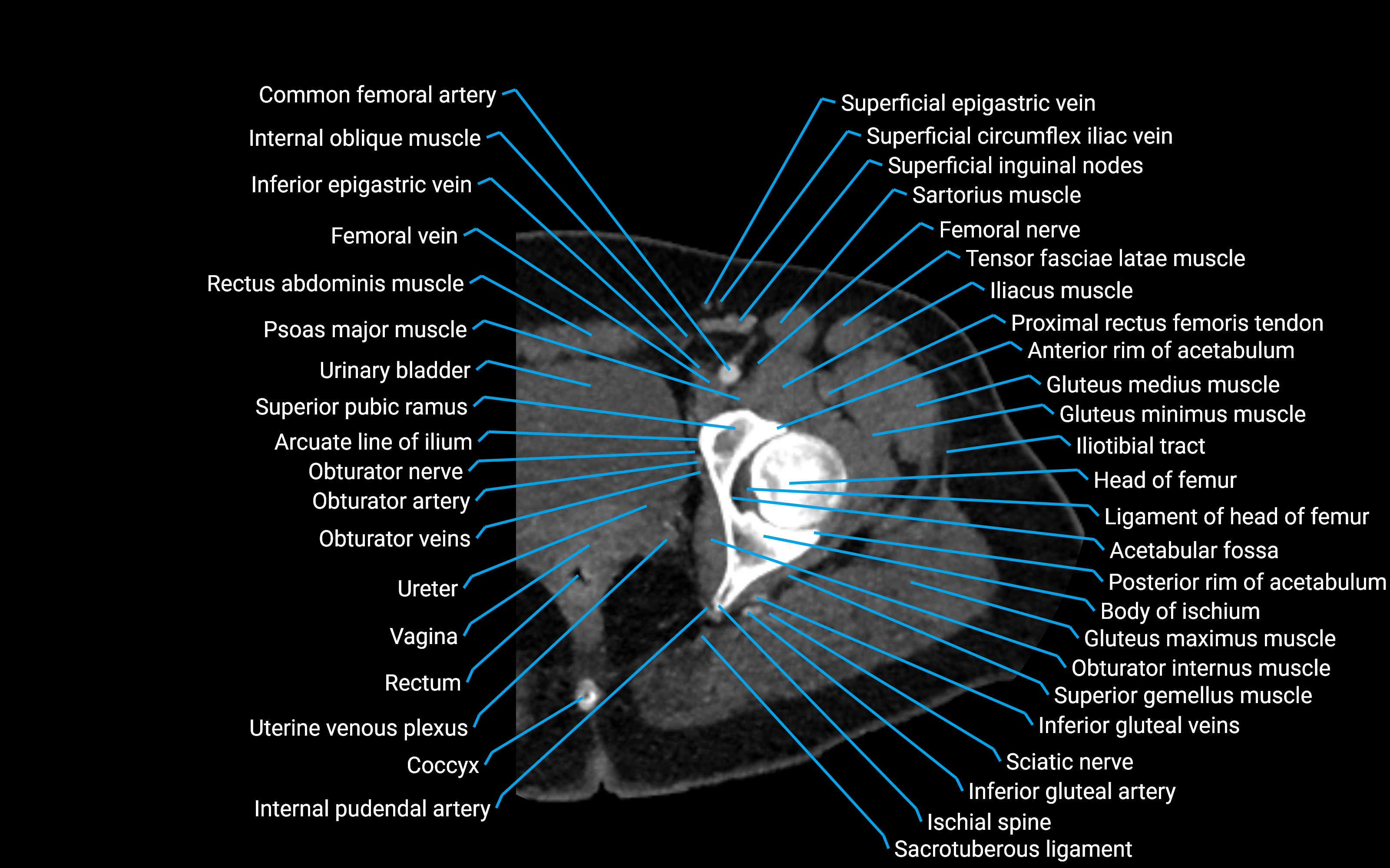 CT Hip axial cross sectional anatomy labelled image 6 (1).png